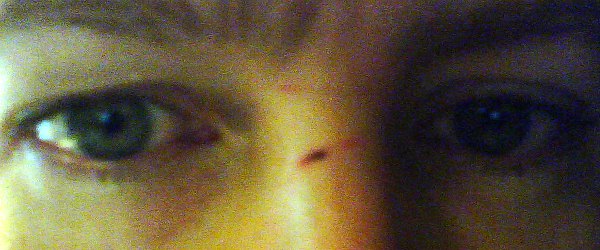 He nearly got my eyes. my damage